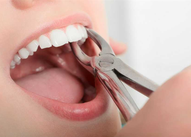 Tooth extraction