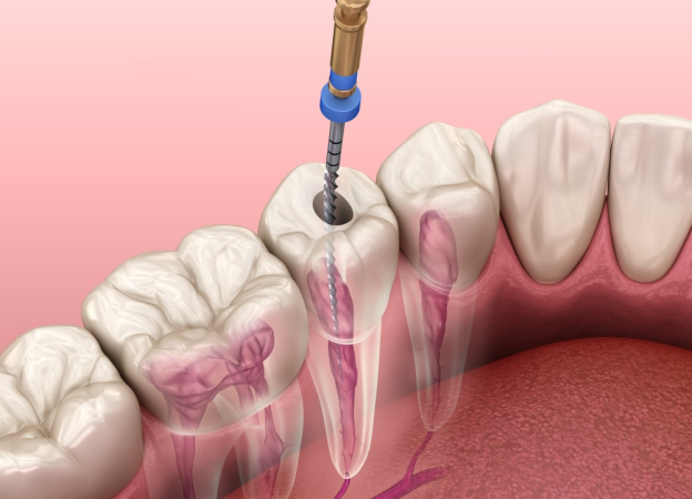 Root canal treatment